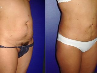 Antes y despues de lipoescultura