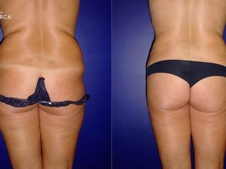 Antes y despues de lipoescultura