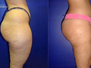 Antes y despues de lipoescultura