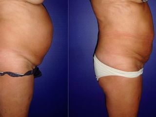 Antes y despues de lipoescultura