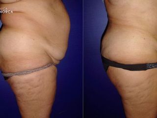 Antes y despues de lipoescultura