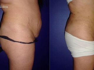 Antes y despues de lipoescultura