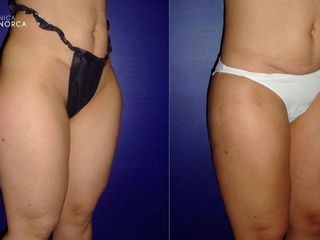 Antes y despues de lipoescultura