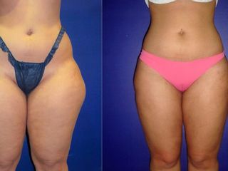 Antes y despues de lipoescultura