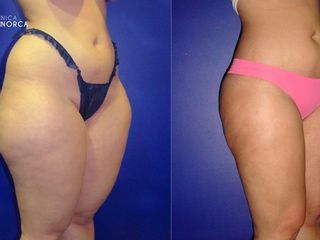 Antes y despues de lipoescultura