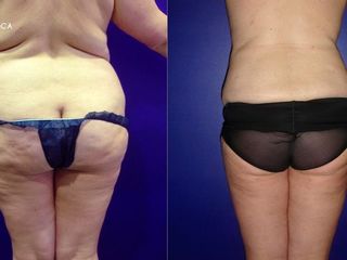 antes y después lipoescultura
