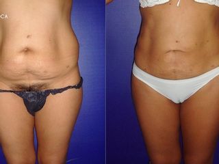 antes y después lipoescultura
