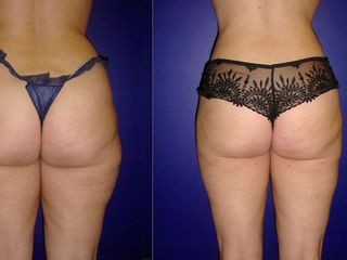 Antes y despues de lipoescultura