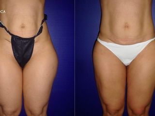 Antes y despues de lipoescultura
