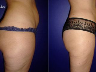 Antes y despues de lipoescultura