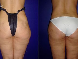 Antes y despues de lipoescultura