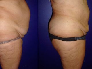 Antes y despues de lipoescultura
