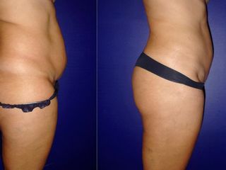 Antes y despues de lipoescultura