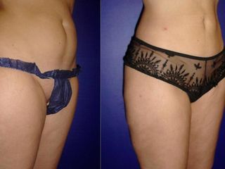 Antes y despues de lipoescultura