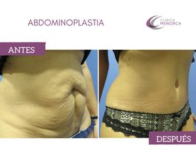 Antes y después de abdominoplastia