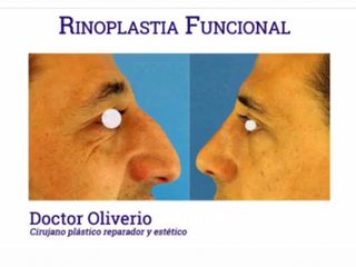 Antes y después RINOPLASTIA FUNCIONAL 