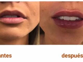 Antes y después aumento de labio 