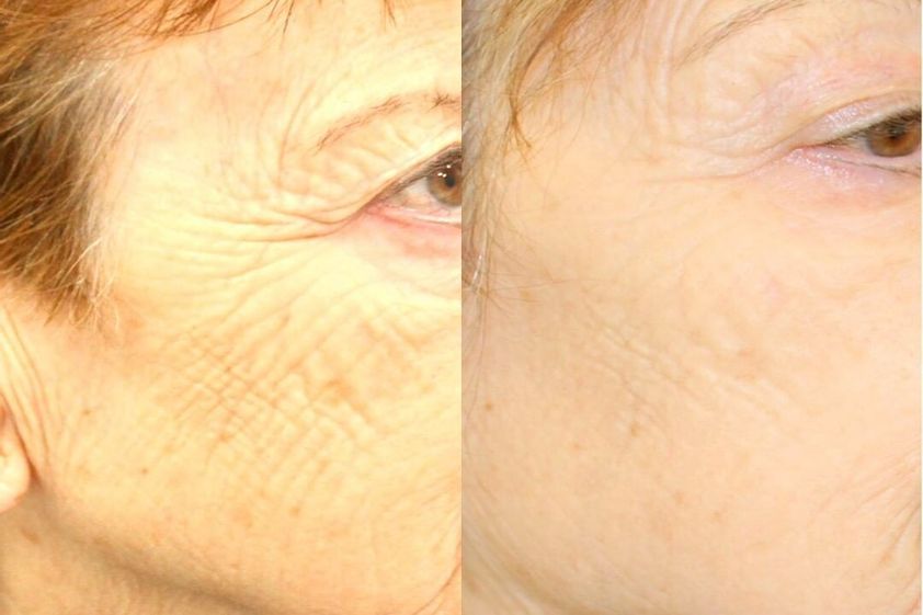Radiofrecuencia facial antes y después - 854407