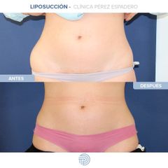 Liposucción - Clínica Pérez Espadero