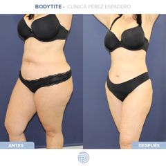 Bodytite - Clínica Pérez Espadero