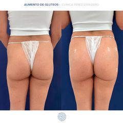 Aumento glúteos - Clínica Pérez Espadero