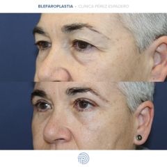 Blefaroplastia - Clínica Pérez Espadero