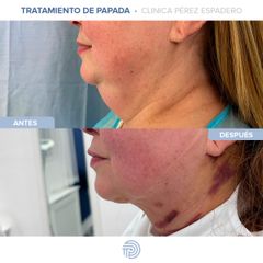 Liposucción de papada - Clínica Pérez Espadero