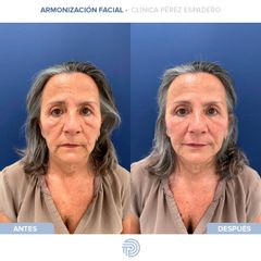 Armonización facial - Clínica Pérez Espadero