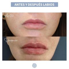 Aumento de labios - Clínica Pérez Espadero