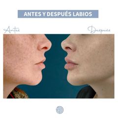 Aumento de labios - Clínica Pérez Espadero