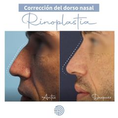 Rinoplastia - Clínica Pérez Espadero