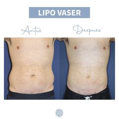 Lipo Vaser - Clínica Pérez Espadero
