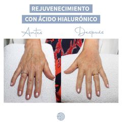 Ácido hialurónico - Clínica Pérez Espadero