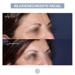 Rejuvenecimiento Facial - Clínica Pérez Espadero