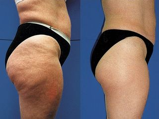 Antes y después Carbo cellulite solution