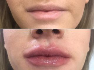 Antes y después Ácido Hialurónico  labios
