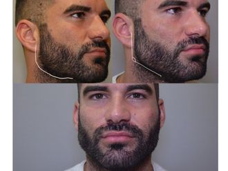 Rellenos faciales - 639663