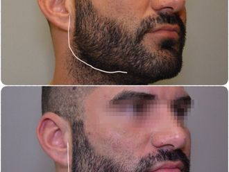 Rellenos faciales - 645316