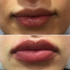 Antes y después Aumento de labios - Clínicas DH