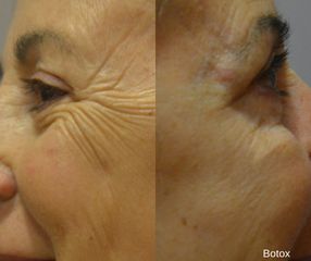 Antes y después Eliminar arrugas - Clínicas DH
