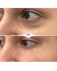 Antes y después Eliminación de ojeras - Clínicas DH