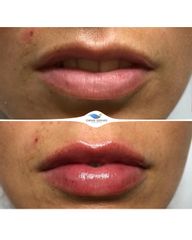 Antes y después Aumento de labios - Clínicas DH