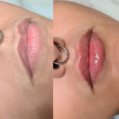 Aumento de labios - Clínicas DH