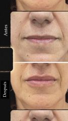 Aumento de labios - Clínicas DH