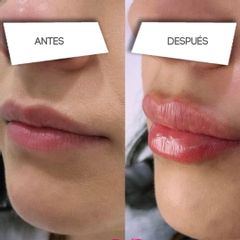 Aumento de labios - Clínicas DH