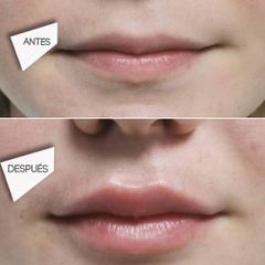 Aumento de labios Clínicas DH