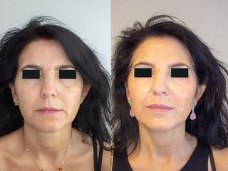 Antes y después Rejuvenece tu rostro en solo unos minutos