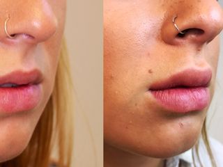 Antes y después Aumento labios 