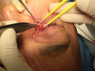 incisión transconjuntival