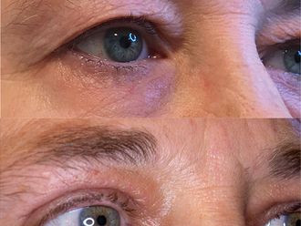 Blefaroplastia - 633559